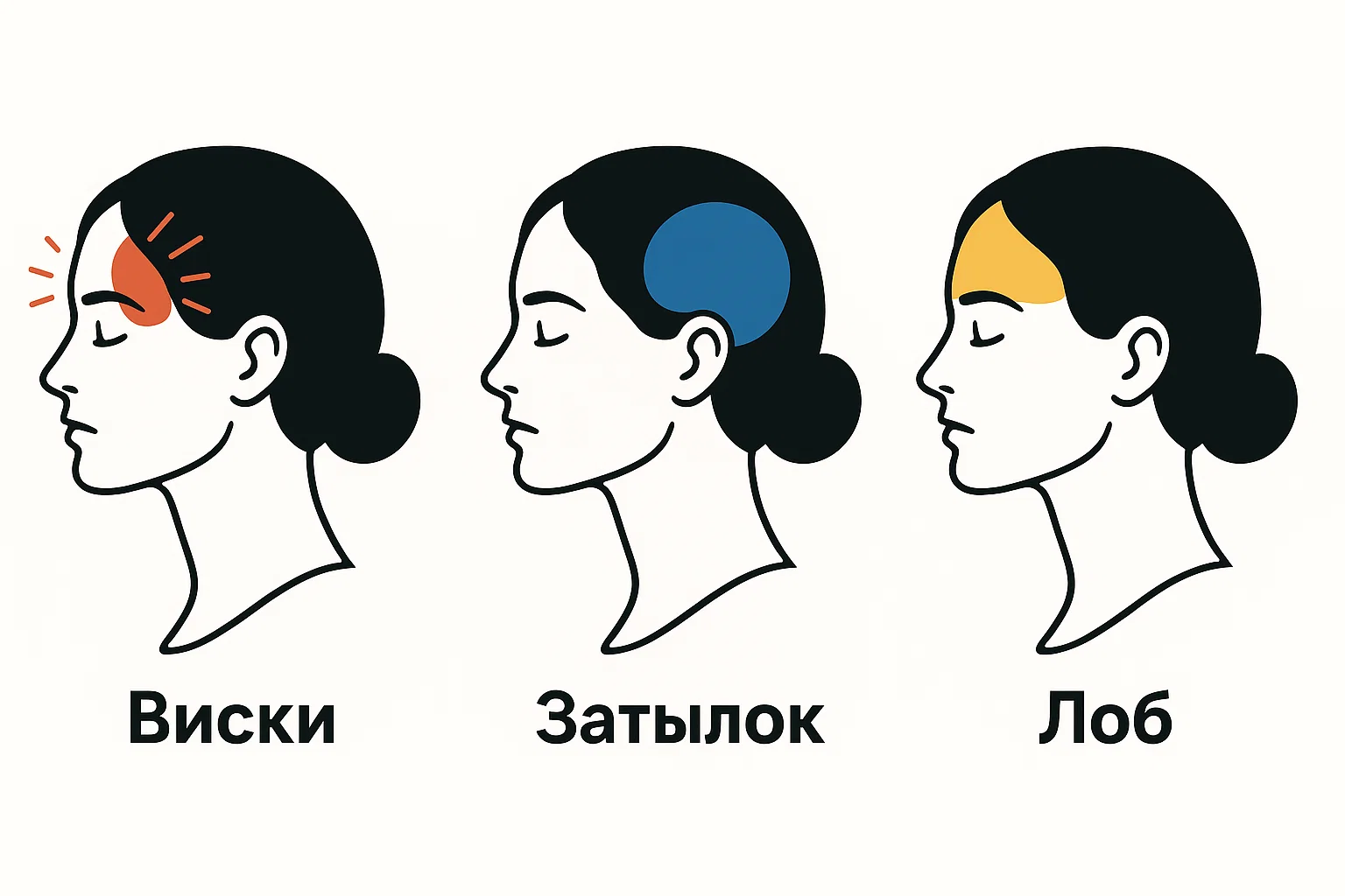 Локализация головной боли: затылок, виски, лоб